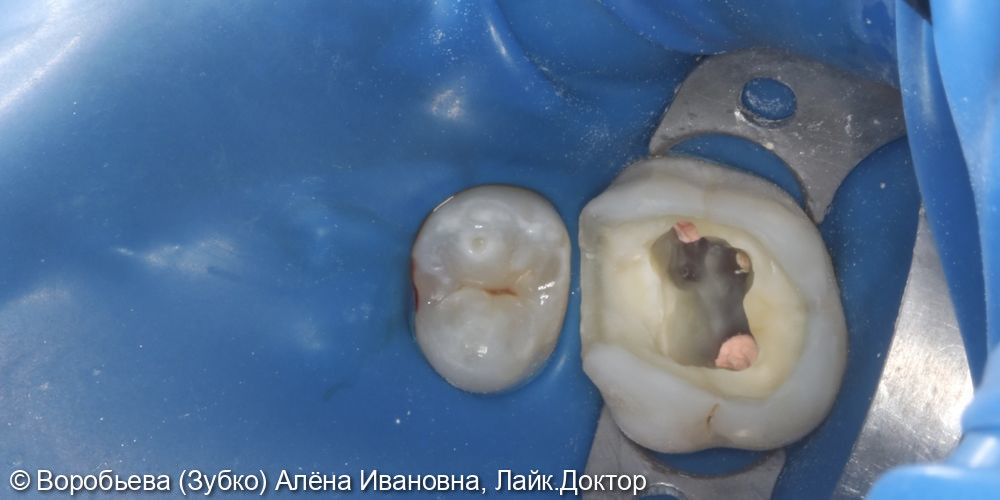 Лечение периодонтита 16 зуба - фото №1