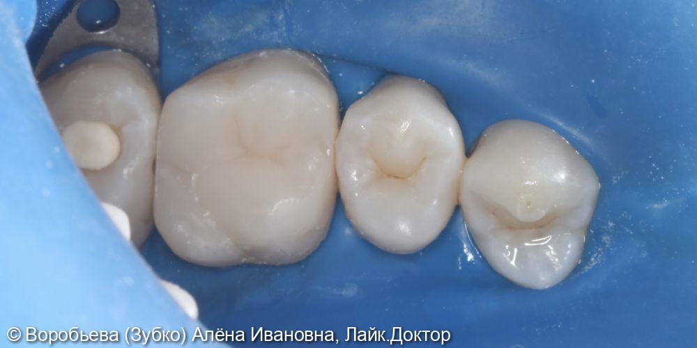 Лечение глубокого кариеса 26 зуба - фото №3
