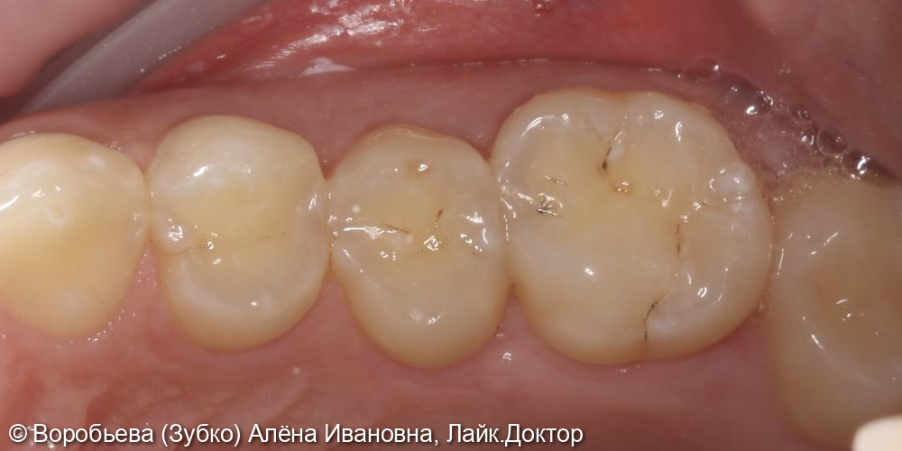 Лечение кариеса 14,15,16 зубов - фото №1