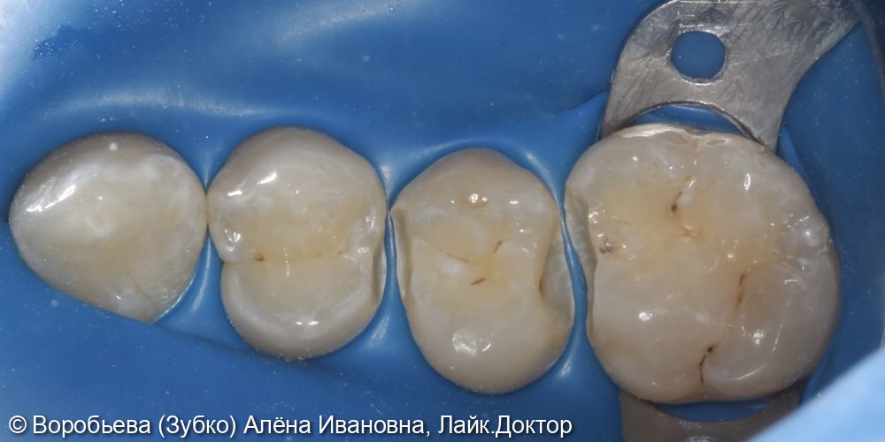 Лечение кариеса 14,15,16 зубов - фото №3