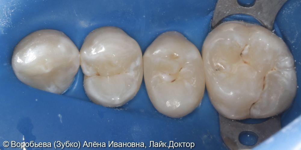 Лечение кариеса 14,15,16 зубов - фото №5