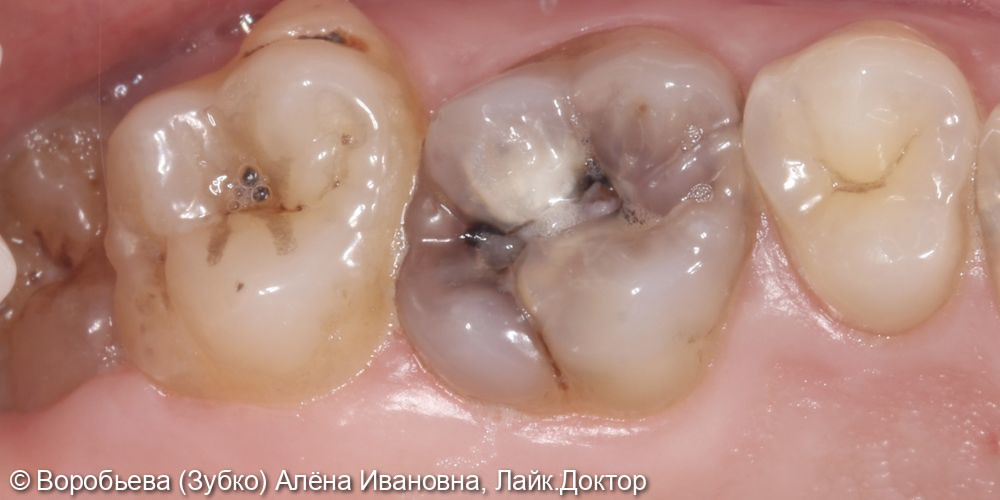 Лечение хронического пульпита 16 зуба - фото №1