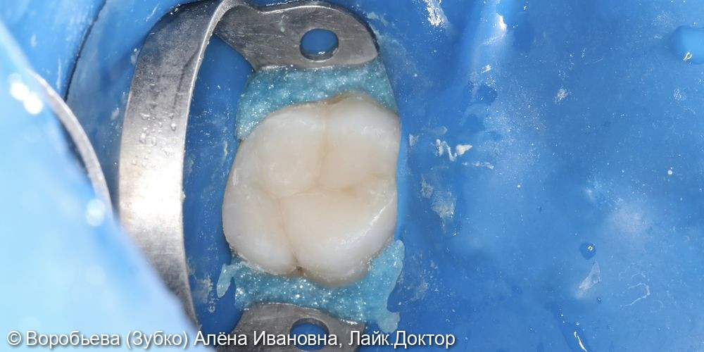 Лечение хронического пульпита 16 зуба - фото №4