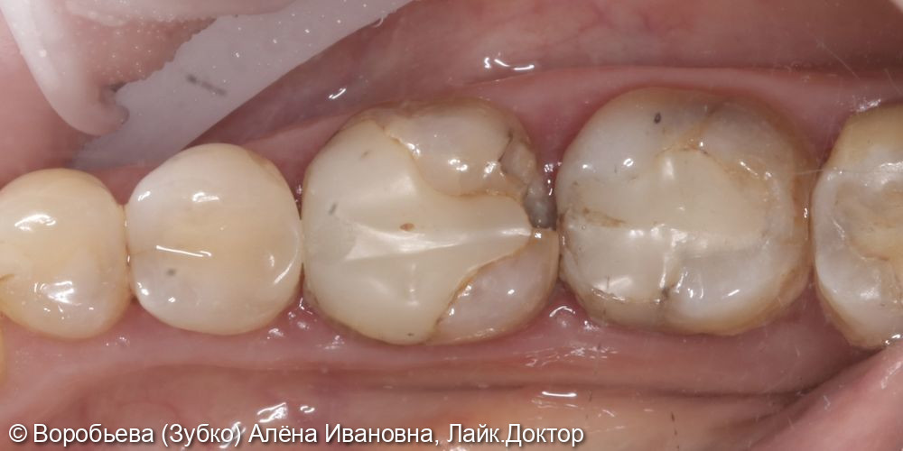 Лечение на хронического пульпита 46 зуба - фото №1