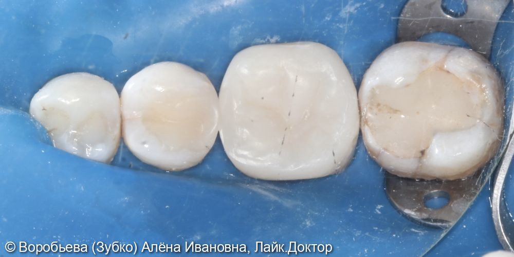 Лечение на хронического пульпита 46 зуба - фото №6
