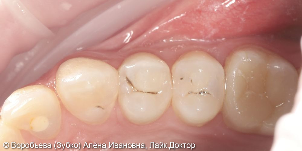 Лечение кариеса 13,14,15 зубов - фото №1
