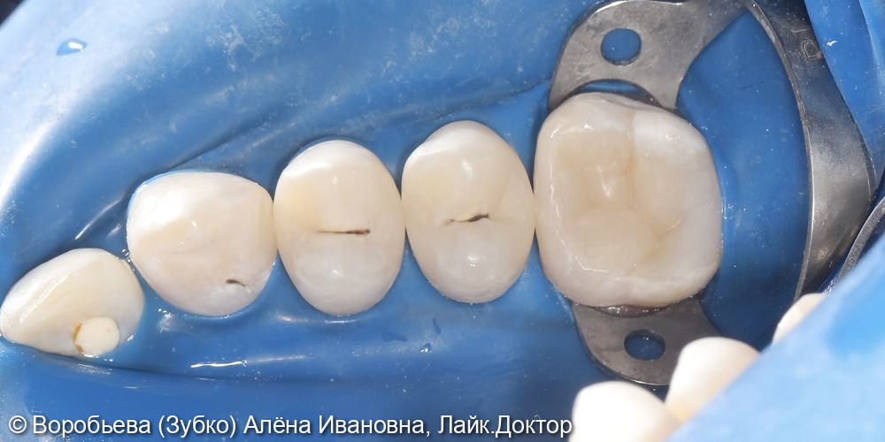 Лечение кариеса 13,14,15 зубов - фото №4