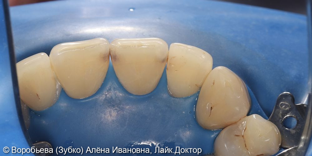 Лечение кариеса 12, 11 и 21 зуба - фото №1