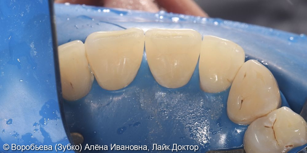 Лечение кариеса 12, 11 и 21 зуба - фото №6