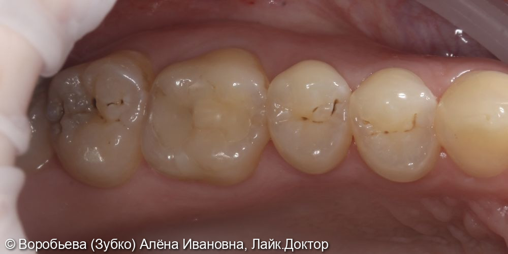 Лечение кариеса 27,26,25 и 24 - фото №1