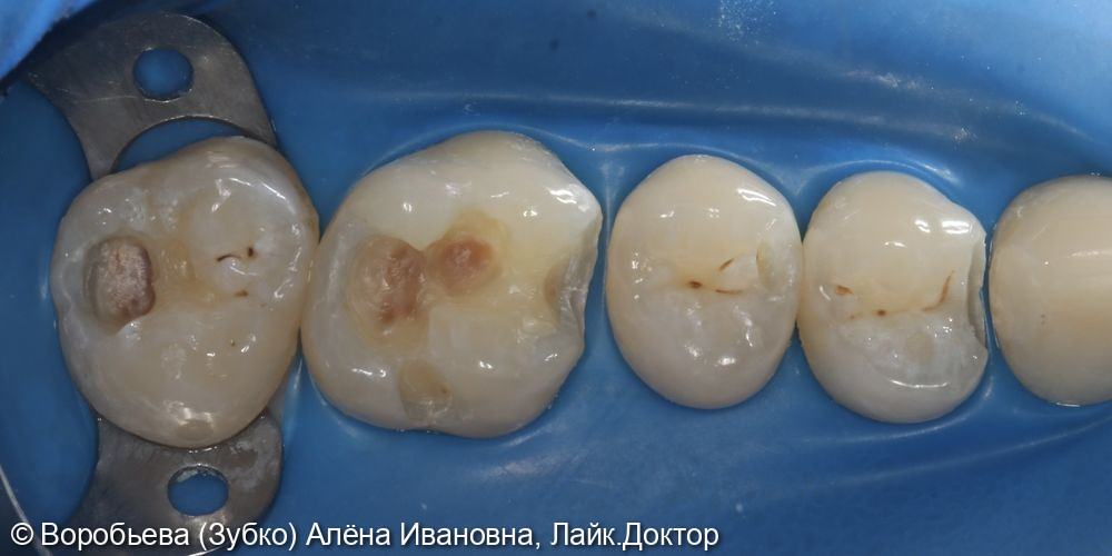 Лечение кариеса 27,26,25 и 24 - фото №2