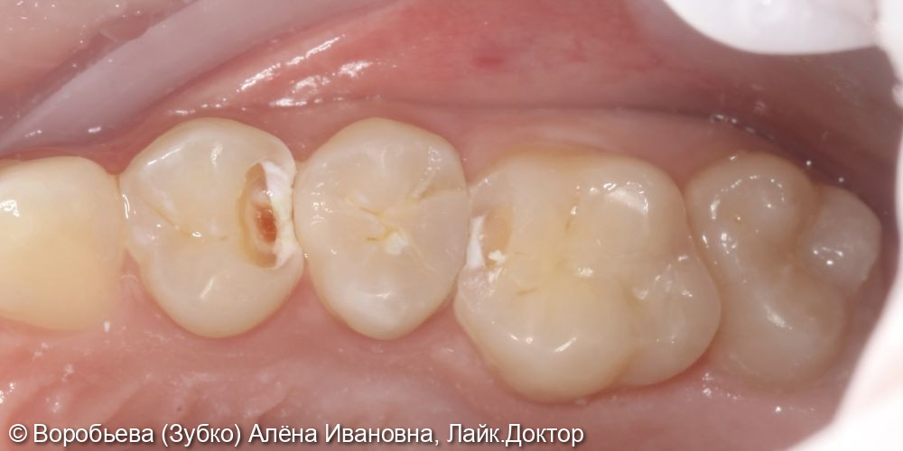 Лечение кариеса 16, 15 и 14 зуба - фото №2