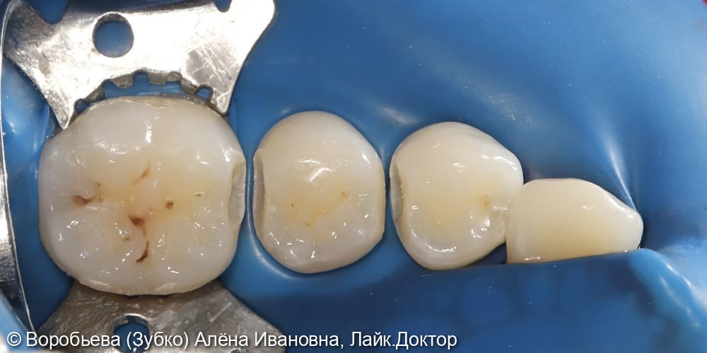 лечение кариеса 45 46 44 зуба фото 2 · Вологда
