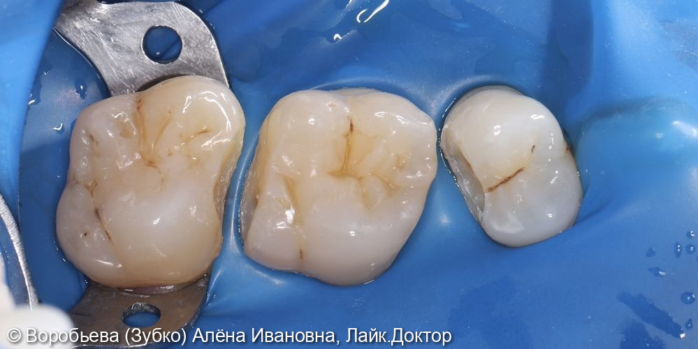 Лечение кариеса 25,26 и 27 го зуба фото 2 · Вологда