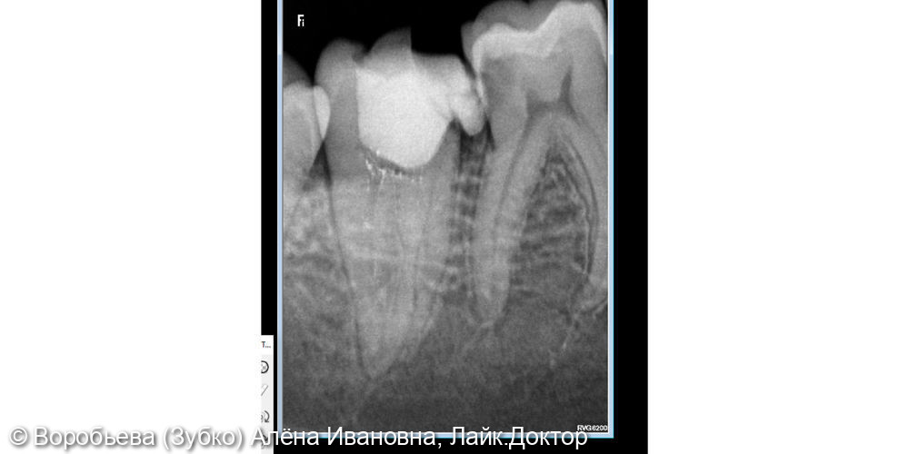 Лечение пульпита 47 зуба и лечение кариеса 46 зуба - фото №2