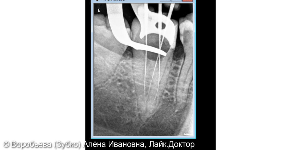 Лечение пульпита 47 зуба и лечение кариеса 46 зуба - фото №4