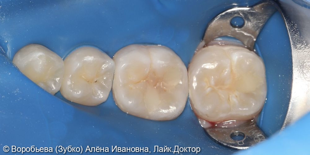 Лечение глубокого кариеса 46 и 47 зубов - фото №2