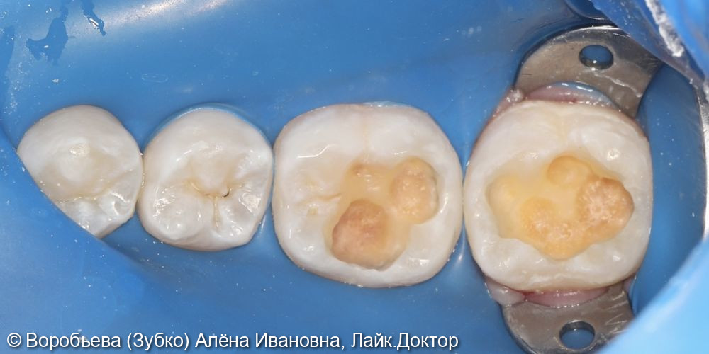 Лечение глубокого кариеса 46 и 47 зубов - фото №3