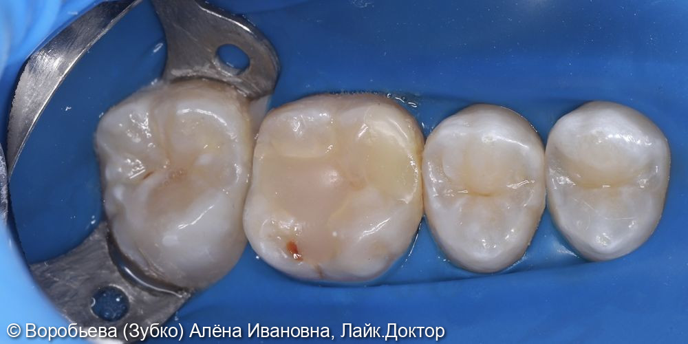 Лечение кариеса 26 зуба и 27 го зуба - фото №1