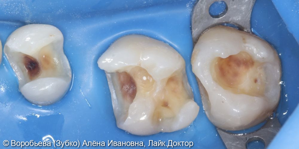 Лечение кариеса 17,16 и 14 зубов - фото №2