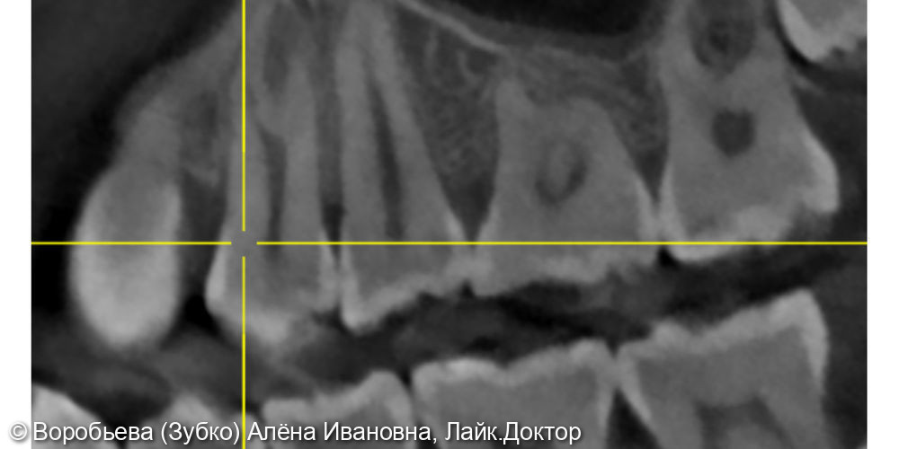 Лечение кариеса 25 и 24 зубов фото 2 · Вологда