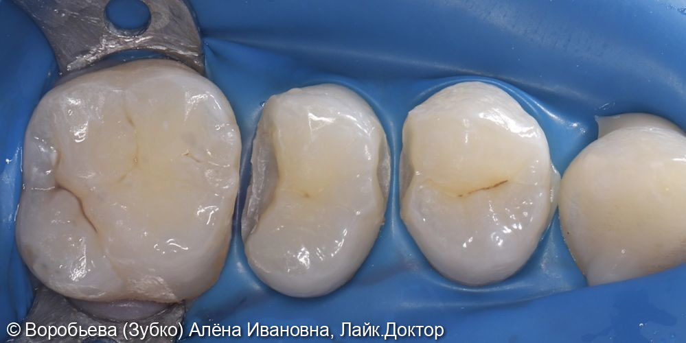 Лечение кариеса 25 и 24 зубов фото 3 · Вологда