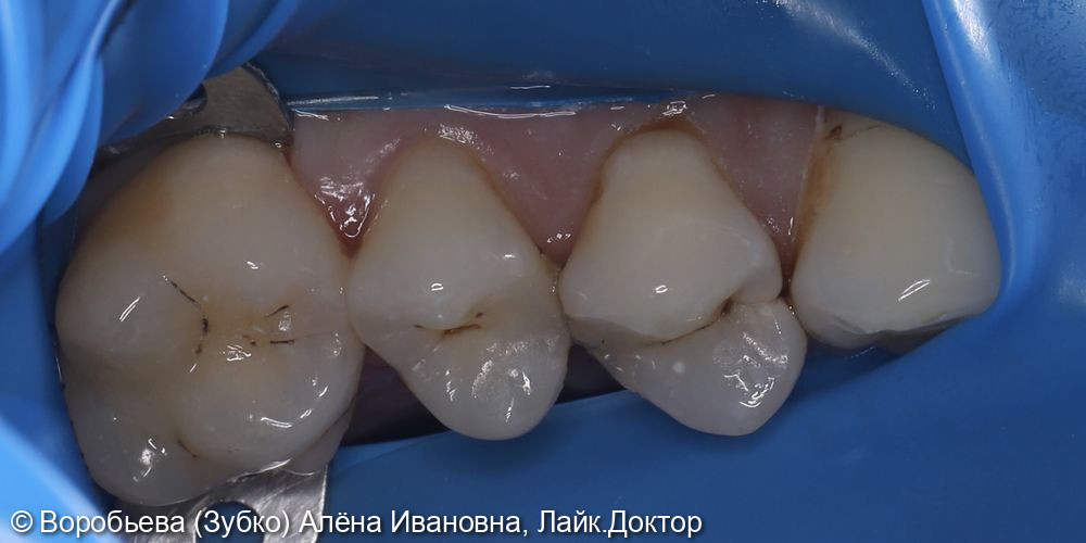 Лечение 24 и 25 зубов фото 2 · Вологда