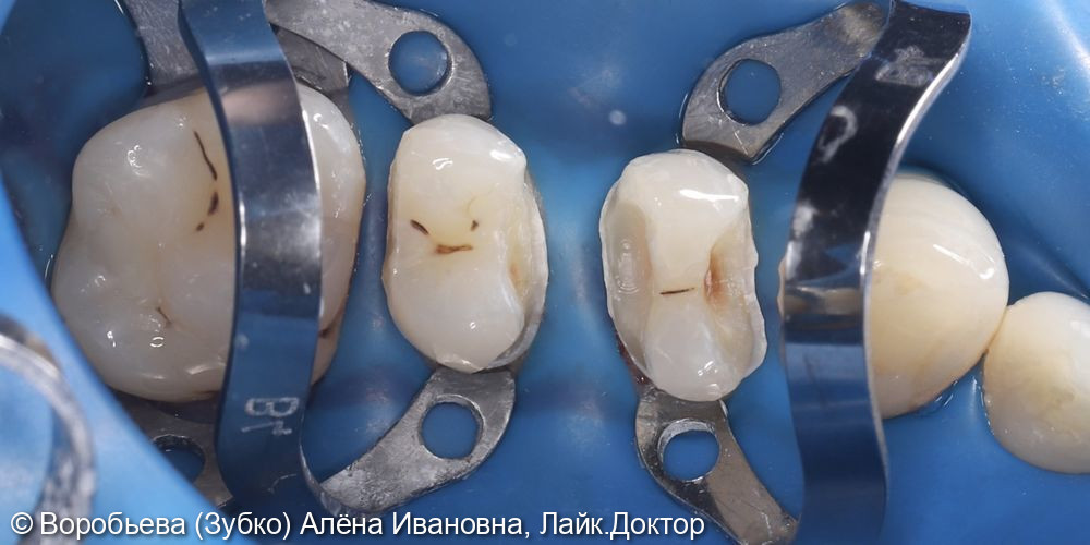 Лечение 24 и 25 зубов фото 3 · Вологда