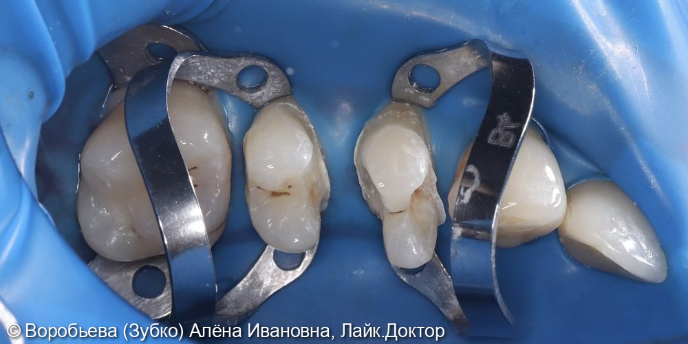Лечение 24 и 25 зубов фото 4 · Вологда
