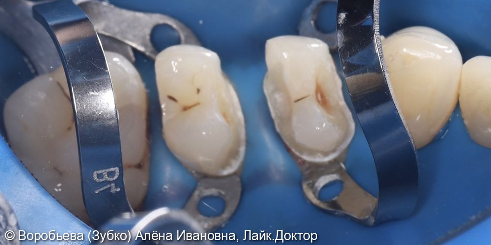 Лечение 24 и 25 зубов фото 5 · Вологда