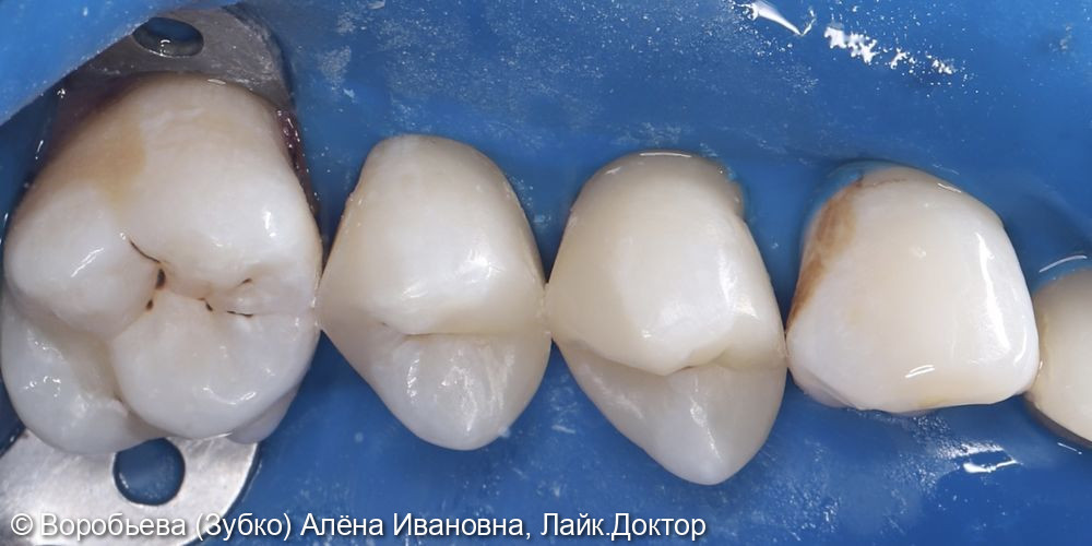 Лечение 24 и 25 зубов фото 6 · Вологда
