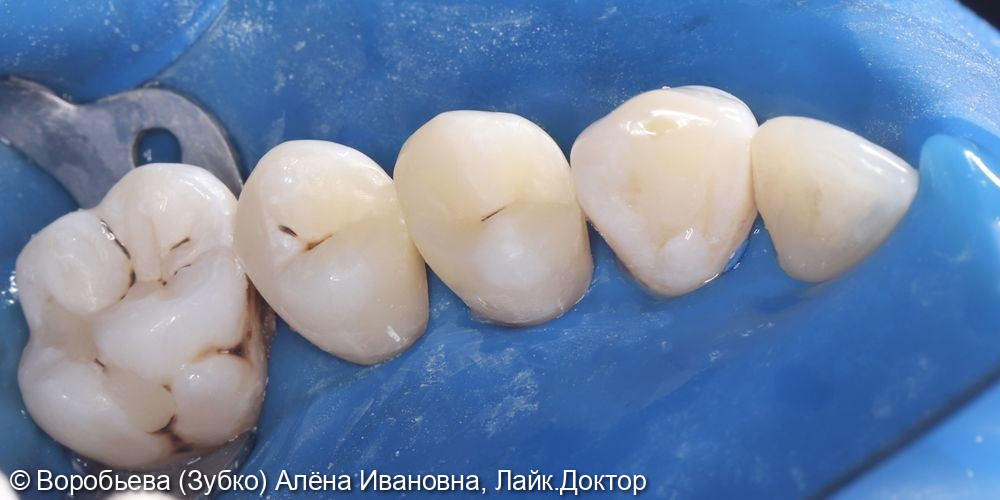 Лечение 24 и 25 зубов фото 7 · Вологда