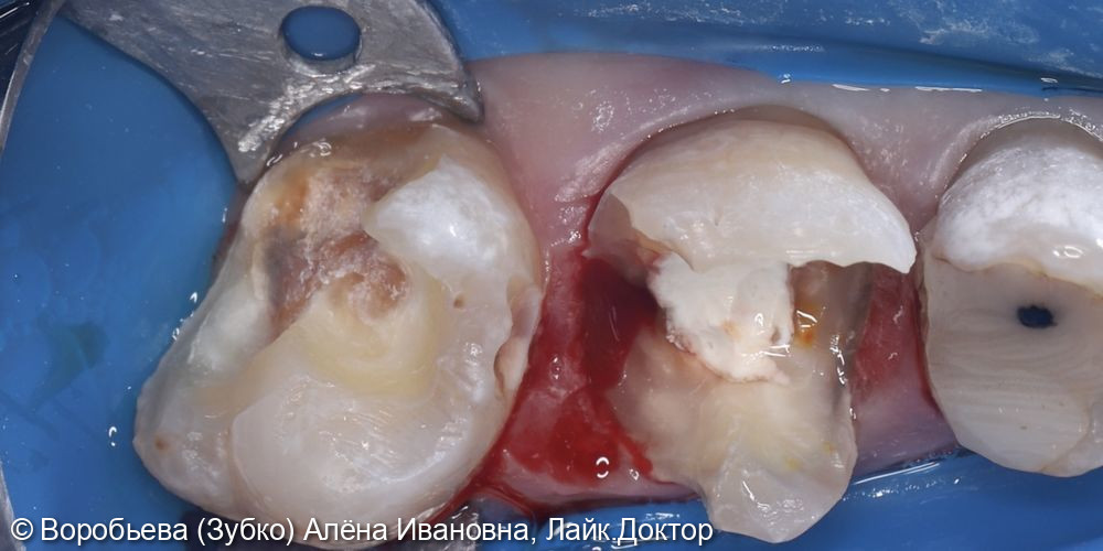 Лечение кариеса 27 зуба и подготовка 36 зуба под коронку - фото №6