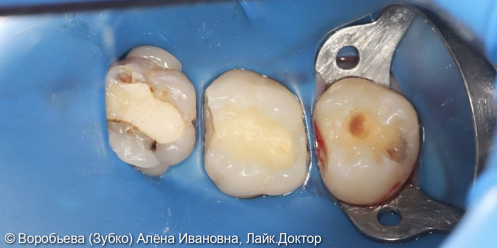 Лечение кариеса 16 и 17 зубов фото 2 · Вологда