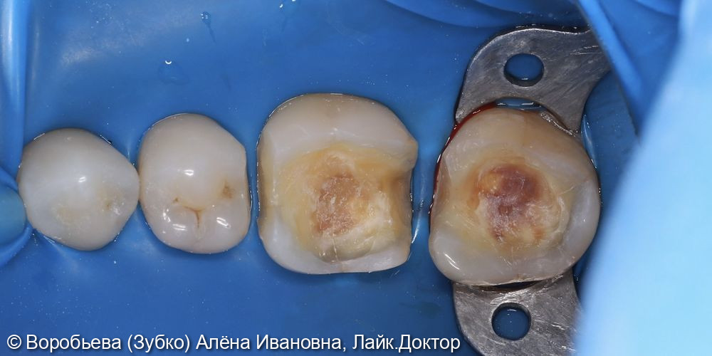 Лечение кариеса 45,46,47 зубов фото 2 · Вологда