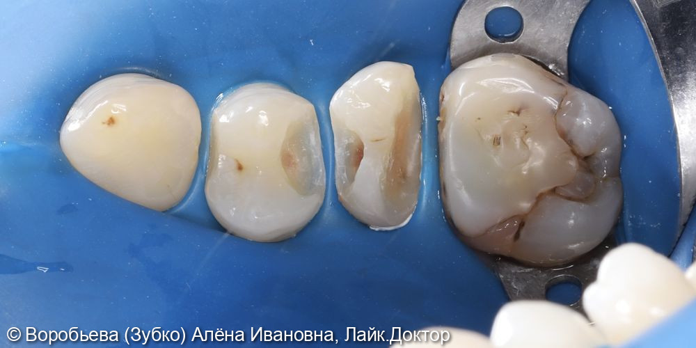 Лечение кариеса 14 и 15 зубов фото 2 · Вологда