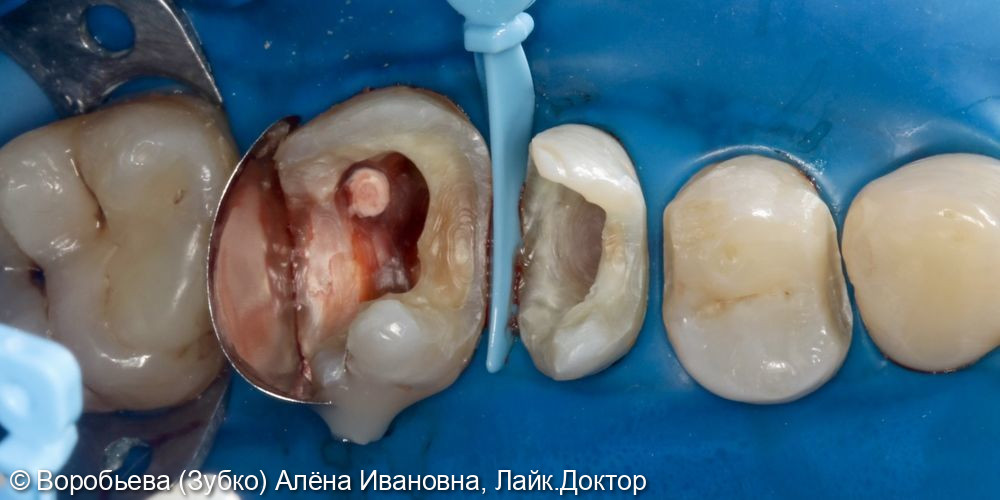 Лечение 25 и 26 зуба фото 2 · Вологда