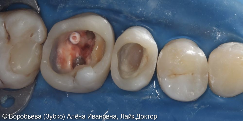Лечение 25 и 26 зуба фото 4 · Вологда