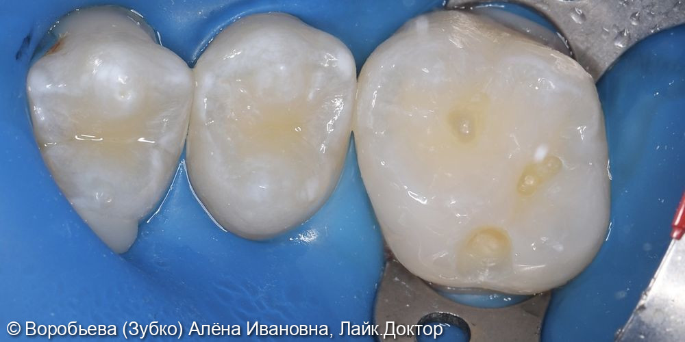 Лечение кариеса 16 зуба фото 2 · Вологда