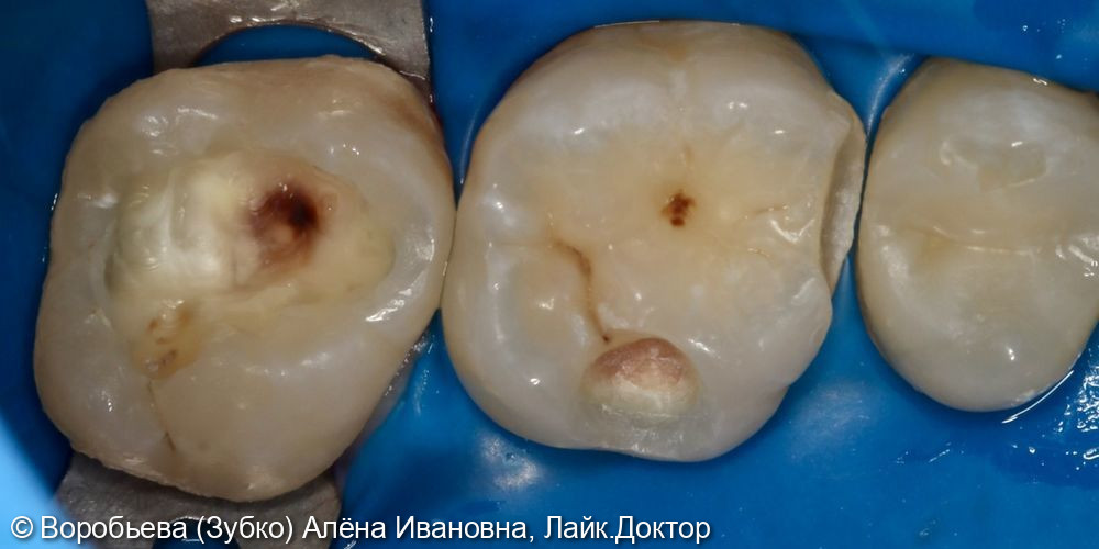 Лечение кариеса 26 и 27 фото 2 · Вологда