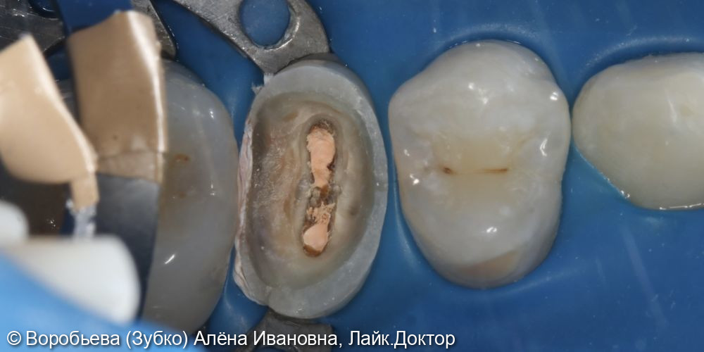 Лечение 25 зуба фото 2 · Вологда