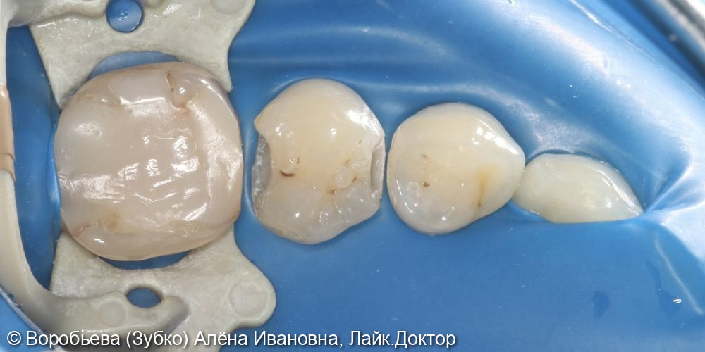 Лечение кариеса 35 зуба фото 2 · Вологда