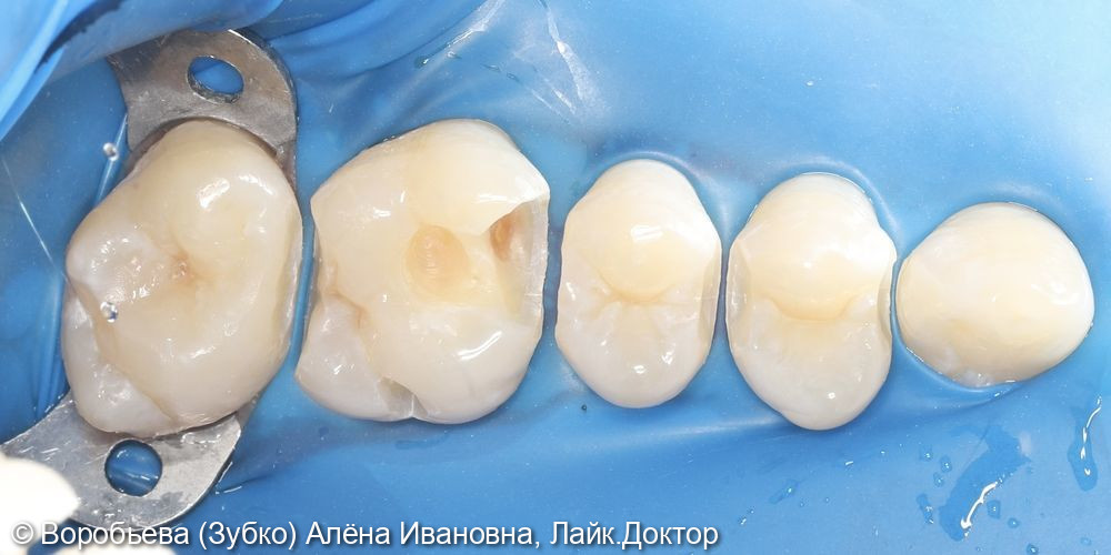 Лечение кариеса 24,25,26,27 зубов фото 2 · Вологда