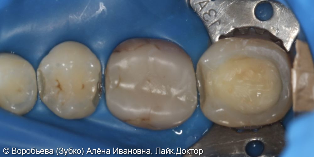 Лечение 45,45 и 47 зубов фото 2 · Вологда