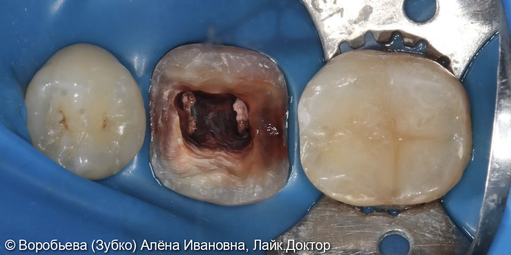 Лечение 45,45 и 47 зубов фото 3 · Вологда