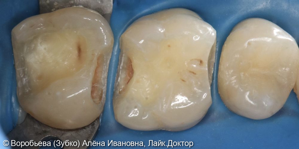 Лечение кариеса 26 и 27 зубов фото 2 · Вологда