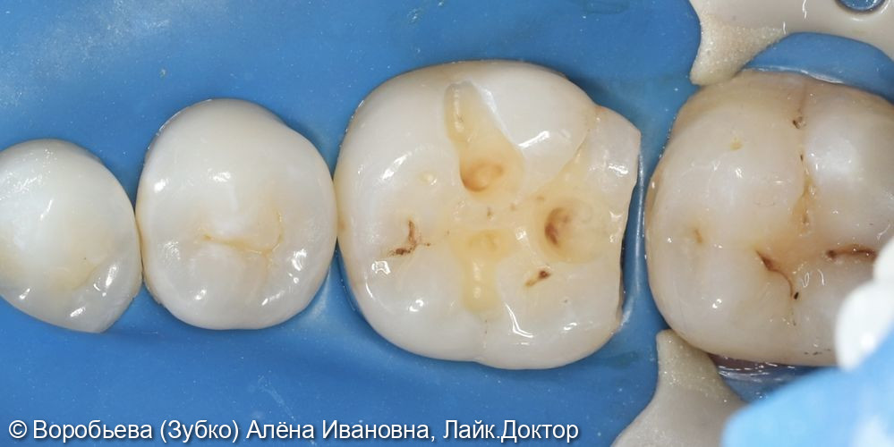 Лечение кариеса 46 зуба фото 2 · Вологда