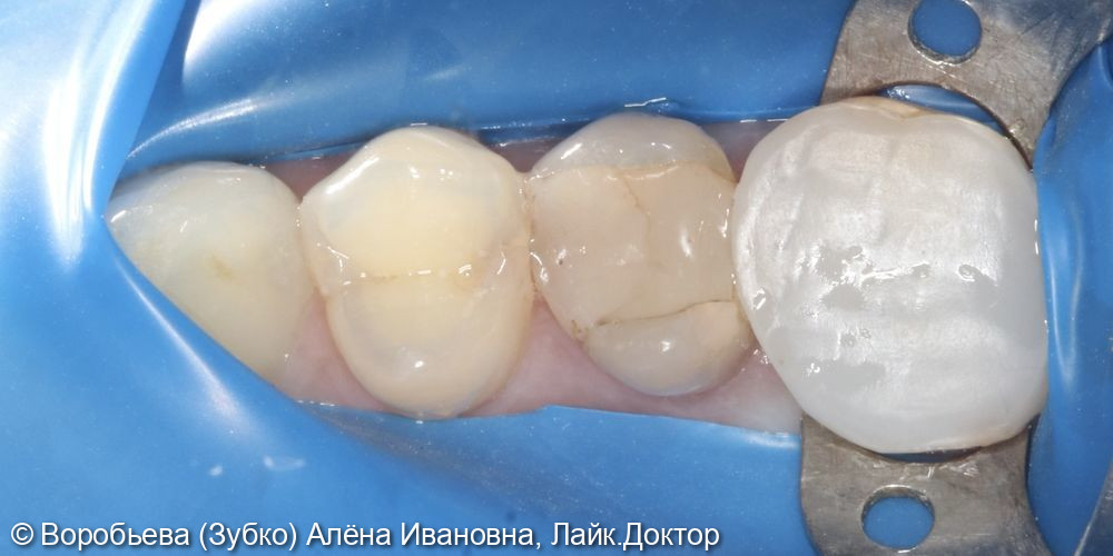 Лечение кариеса 14 и подготовка 15 зуба - фото №1