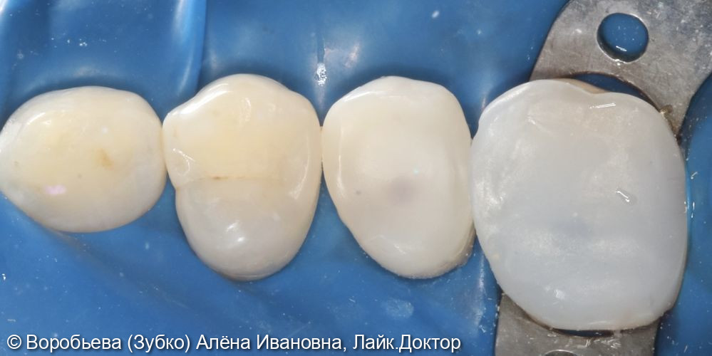 Лечение кариеса 14 и подготовка 15 зуба - фото №3