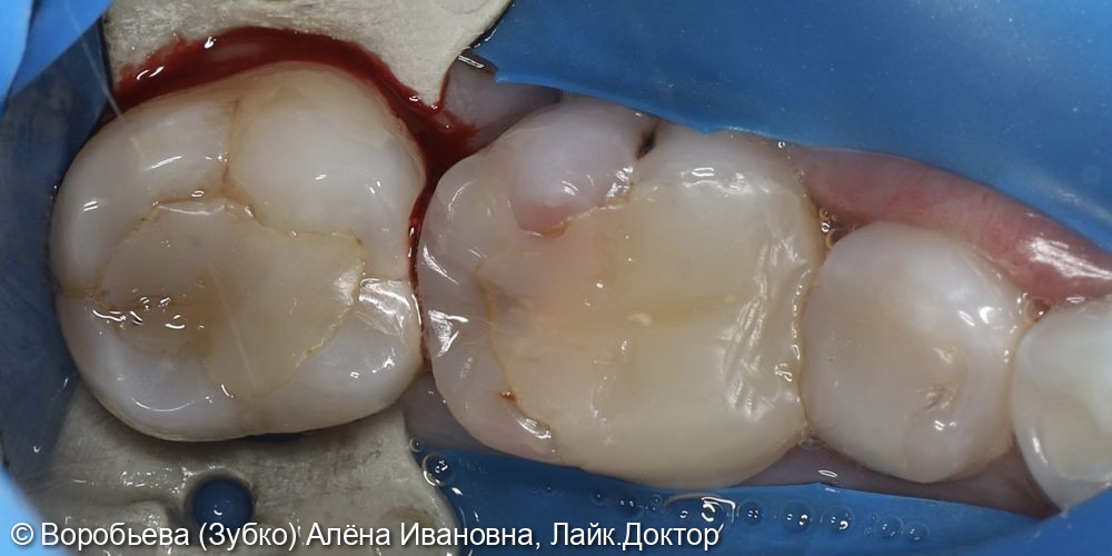Лечение пульпита 37 зуба - фото №1